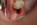 Vista del implante en boca